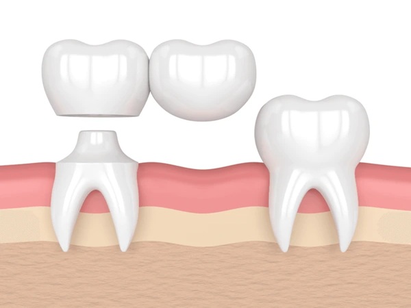 Dental Bridges